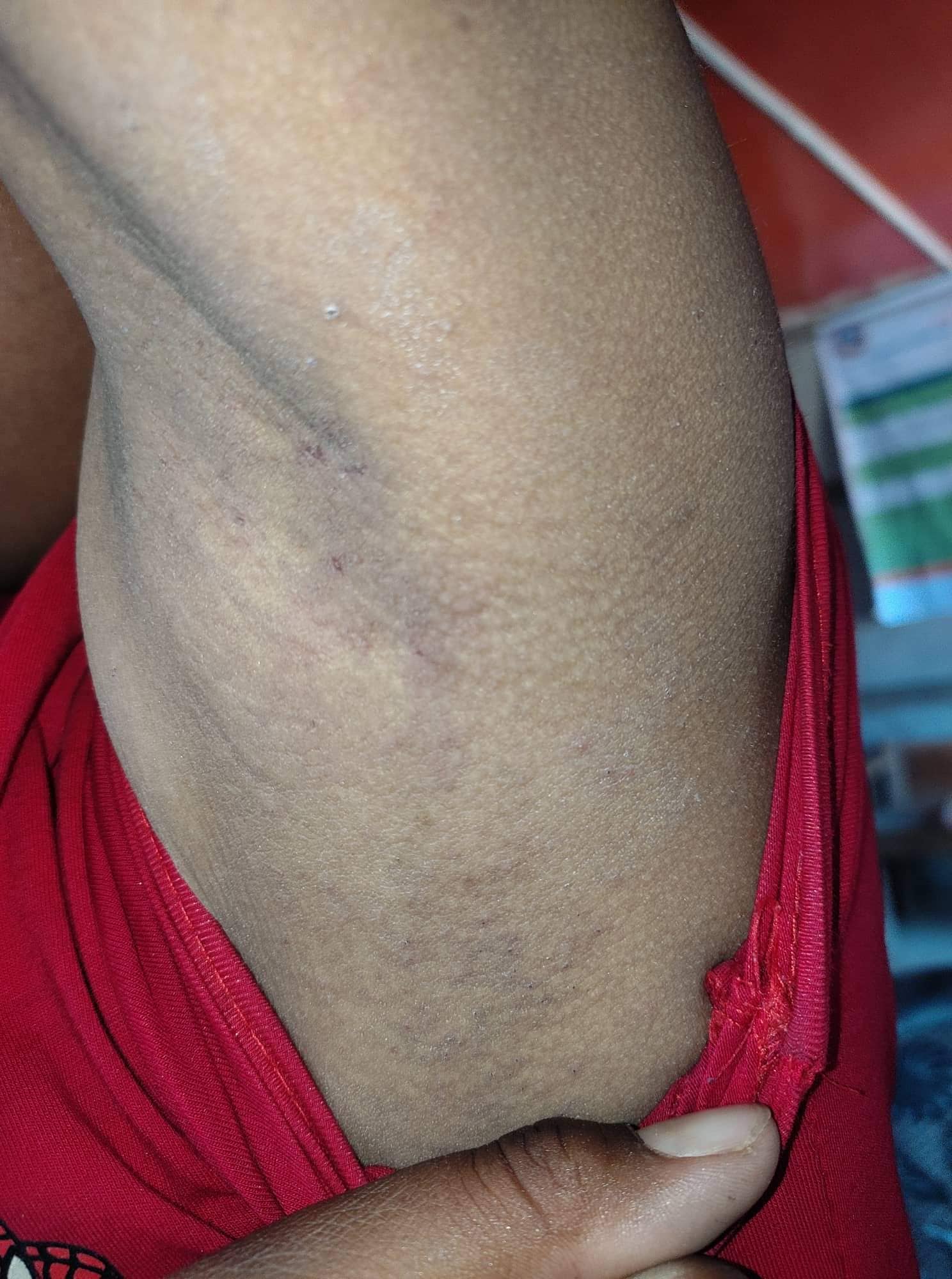 एउटै विद्यालयका ५७ जना विद्यार्थीमा देखियो ठेउला रोग