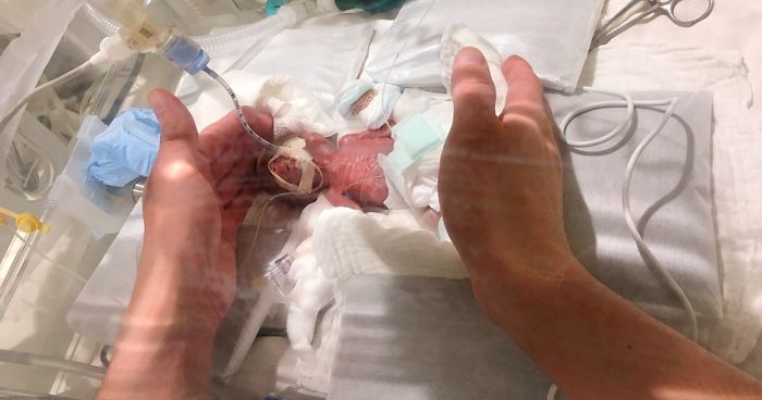 अनौठो घटना : स्याउजत्रो आकारको बालक, अस्पतालबाट डिस्चार्ज गर्ने तयारी