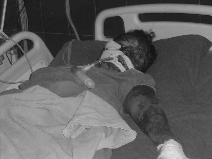 नवलपुर एसिड प्रकरण : जसले भाउजू भनेर बोलाउथ्यो उसैले एसिड हान्यो