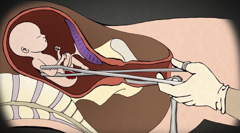 असुरक्षित गर्भपतन : मृत्युको मुखमा बालिका