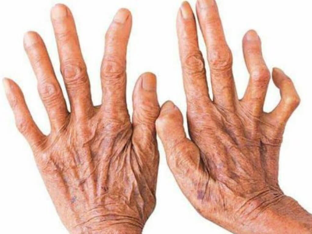 चितवनमा १८ जनामा कुष्ठरोगको सङ्क्रमण