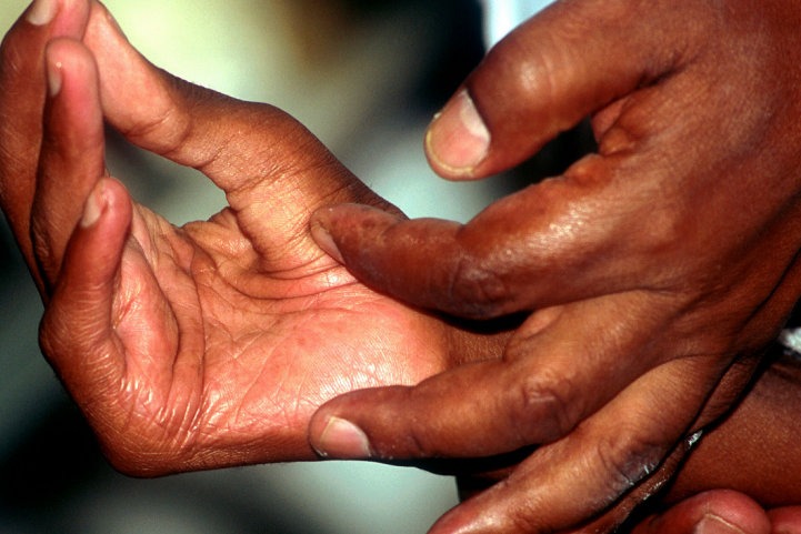 ‘रोगलाई जितेँ, समाजसँग हारेँ’