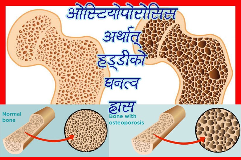 बुढेसकालमा हड्डी कमजोर बनाउने रोग ‘ओस्टियोपोरोसिस’