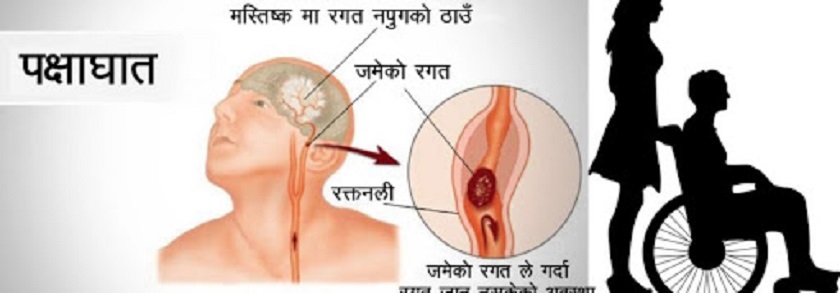 ‘विश्वमा बर्सेनि एक करोड ३० लाखलाई पक्षाघात’